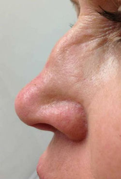non surgical dermal filler nose job before NZ